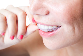 Woman inserting invisible braces