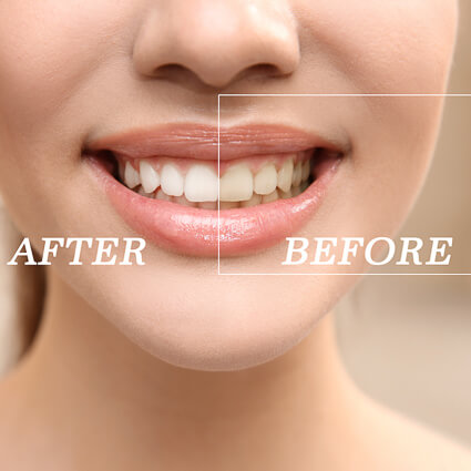 before and after teeth whitening