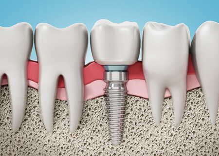 Dental Implants illustration