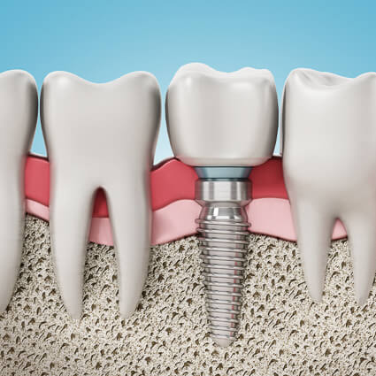 Dental Implants illustration