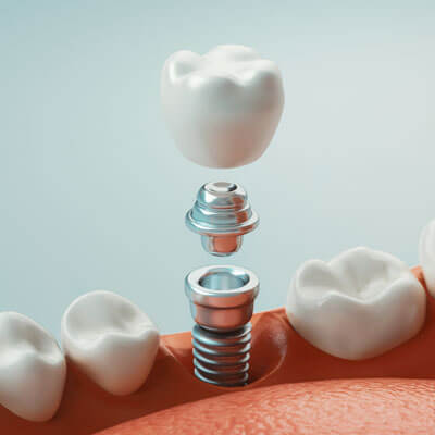 illustration of a dental implant