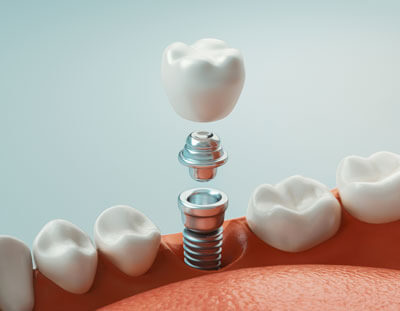 Dental implant illustration