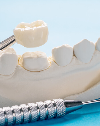 Dental crown illustration