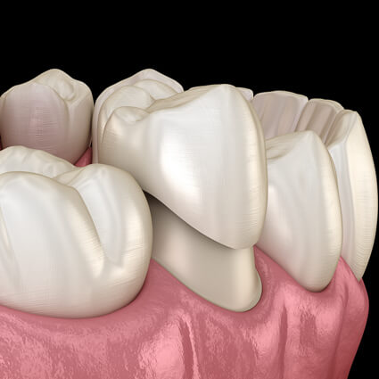 model of a dental crown on teeth