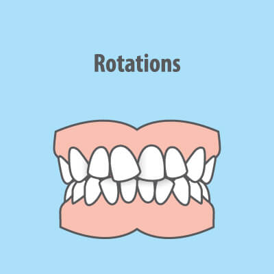 teeth rotations illustrations