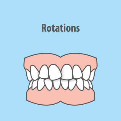 misaligned teeth