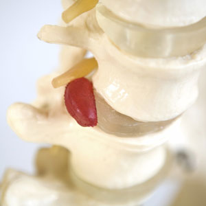 Herniated Disc popping out of spine model