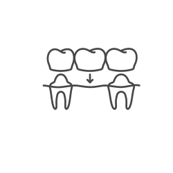 illustration of dental bridge