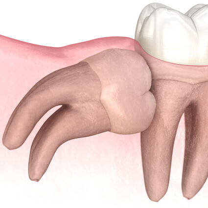 severe horizontal wisdom tooth impaction