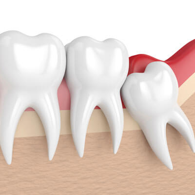 illustration of wisdom teeth in gums