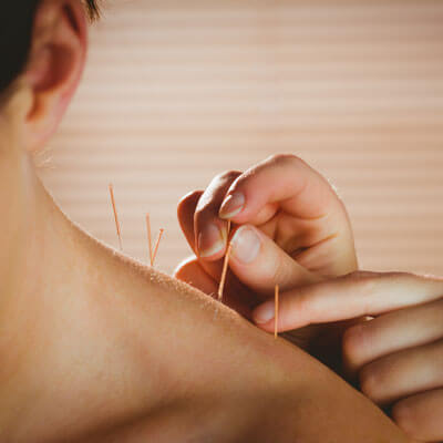 Acupuncture needles being inserted into shoulder