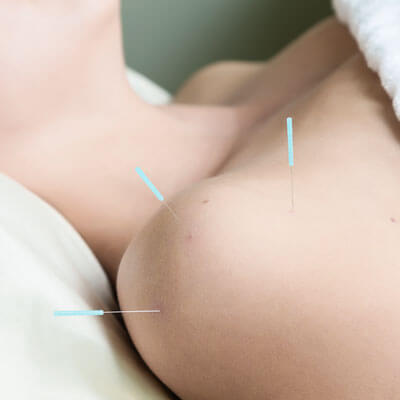Needles in shoulder