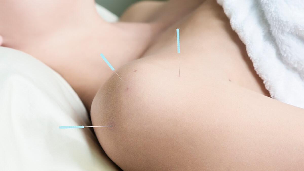 closeup of shoulder with acupuncture needles