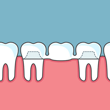 illustration of a dental bridge