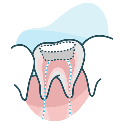 Dental root canal graphic