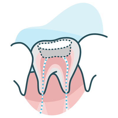 Root canal illustration