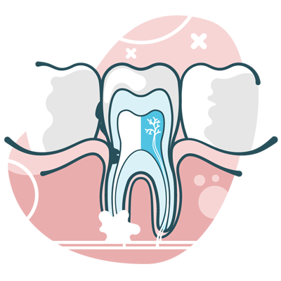 Root canal illustration