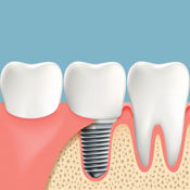 Illustration of dental implant