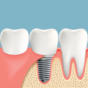 Dental Implants Geraldton