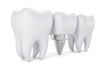 Dental implant image