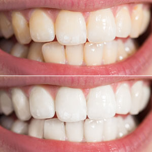 before and after teeth whitening