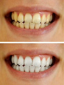 Before and after teeth whitening