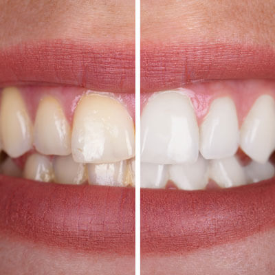 Teeth before and after whitening