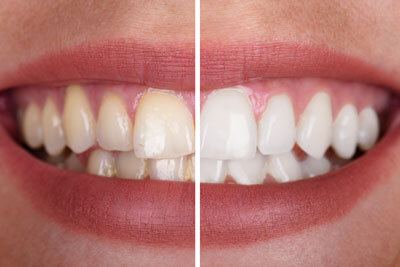 Woman smile before and after whitening