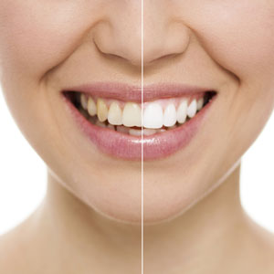 before and after photo of a woman with teeth whitening