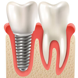 tooth and implant illustration