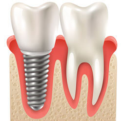 Tooth Implant {PJ}