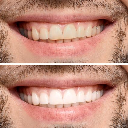 before and after of teeth whitening on man
