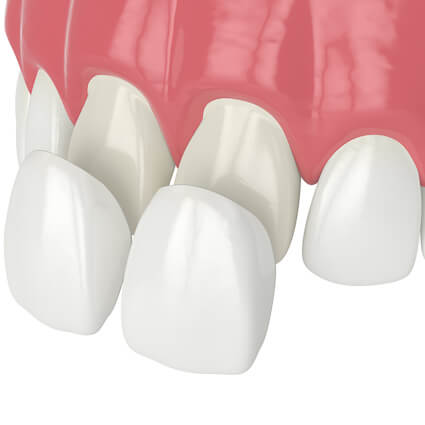 illustration of dental veneers