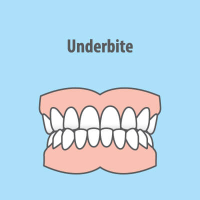 underbite illustration