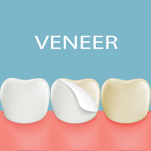 Veneers at Fine Dentistry
