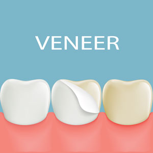 Illustration of dental veneers