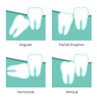 Illustration of wisdom teeth issues