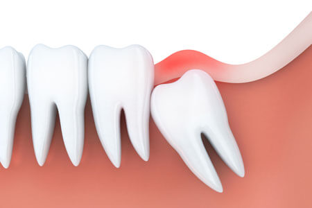 Wisdom tooth under gum