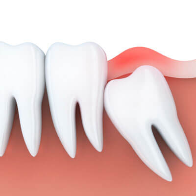 illustration of wisdom teeth in gums