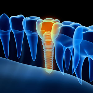 dental implants