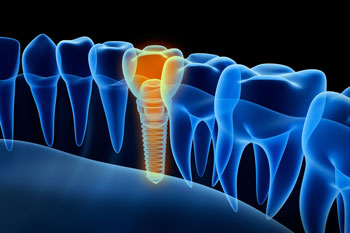 Illustration of a single dental implant