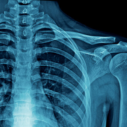 x-ray