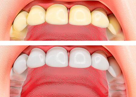 Teeth Whitening illustration